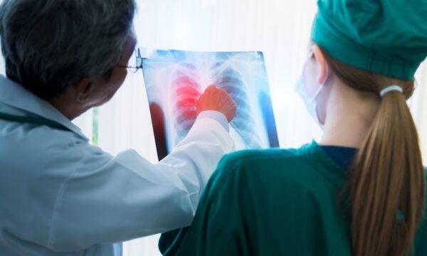 Anvisa aprova novo medicamento para câncer de pulmão