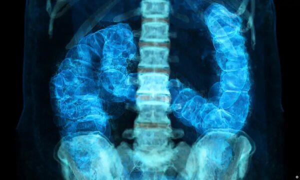 Diagnóstico precoce pode curar mais de 90% dos casos de câncer de intestino; veja os sinais de alerta