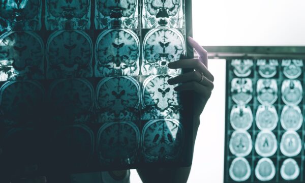 Estudo revela que células de defesa do cérebro podem ajudar a combater o Alzheimer