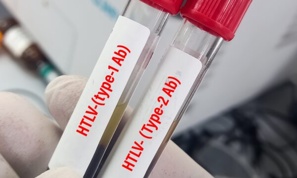 Estudo brasileiro usa retrovírus HTLV-1 para investigar avanço da esclerose múltipla progressiva